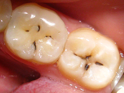 Кариес зубов этиология патогенез лечение thumbnail