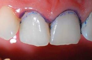 Красители для выявления зубных отложений - Индикаторы зубных отложений